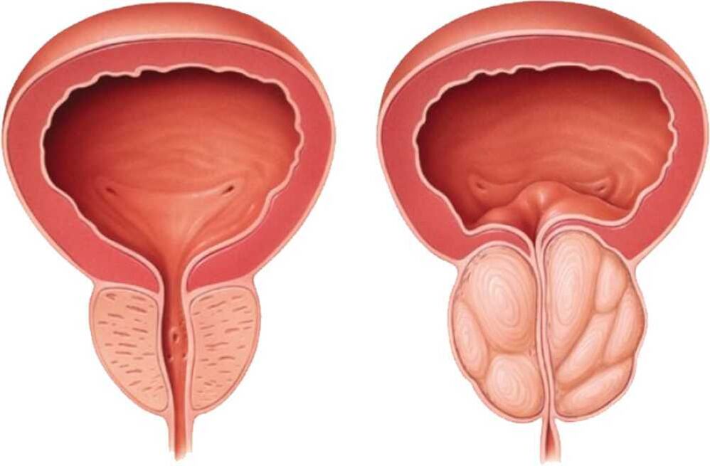 painful prostate